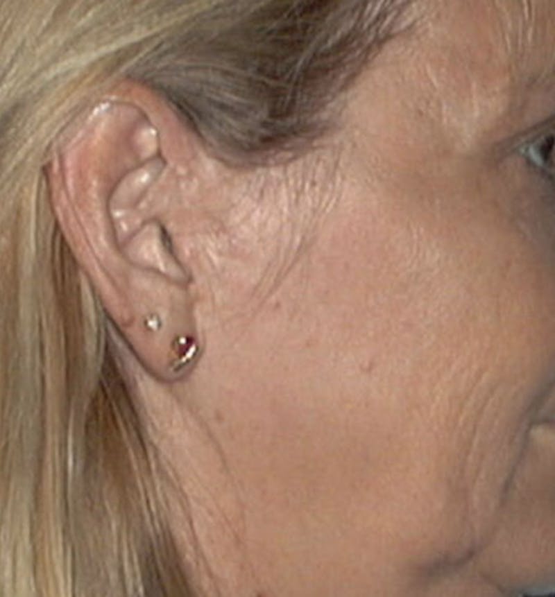 Facelift Scar Before & After Gallery - Patient 133024042 - Image 1