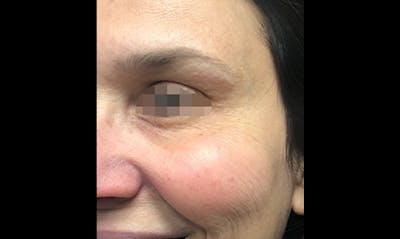 BOTOX Before & After Gallery - Patient 133024041 - Image 2