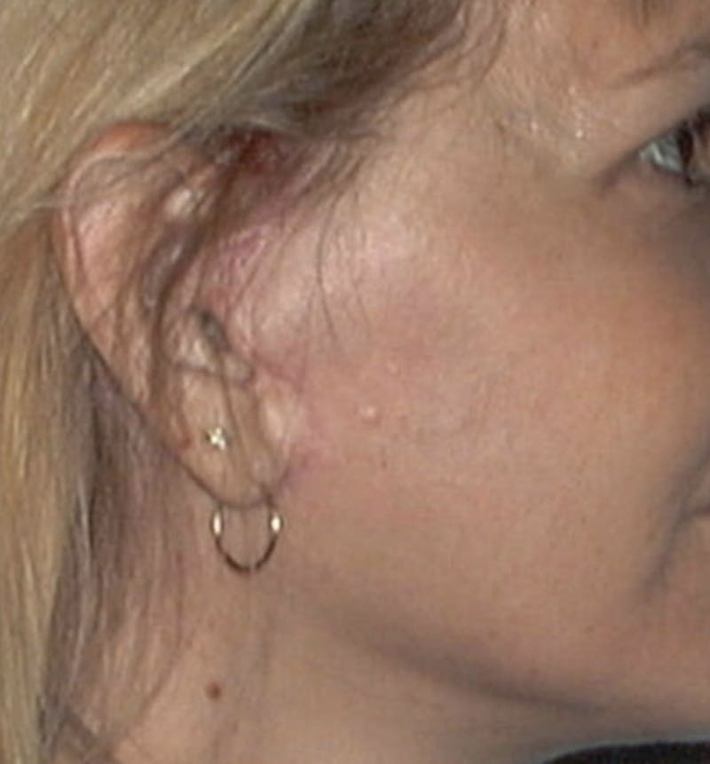 Facelift Scar Before & After Gallery - Patient 133024042 - Image 2