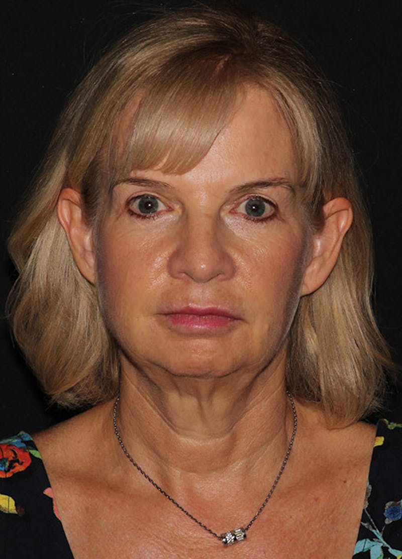 Facelift & Necklift Before & After Gallery - Patient 133024054 - Image 1