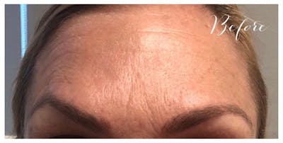 BOTOX Before & After Gallery - Patient 133024045 - Image 1