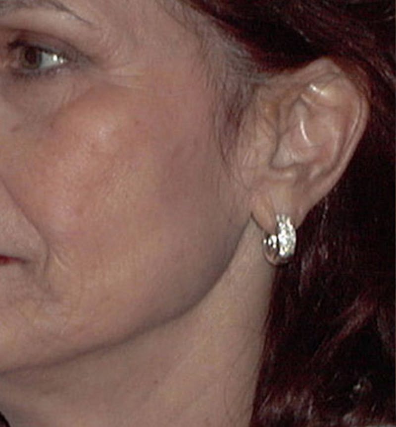 Facelift Scar Before & After Gallery - Patient 133024048 - Image 1