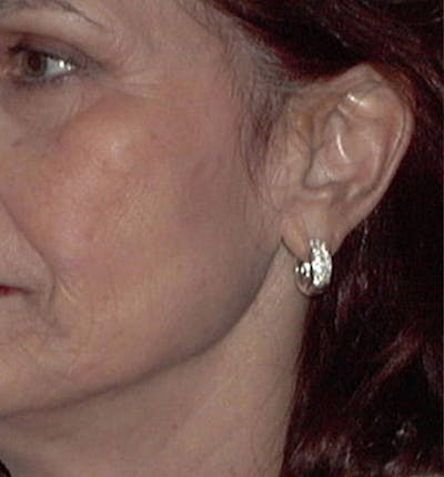 Facelift Scar Before & After Gallery - Patient 133024048 - Image 1