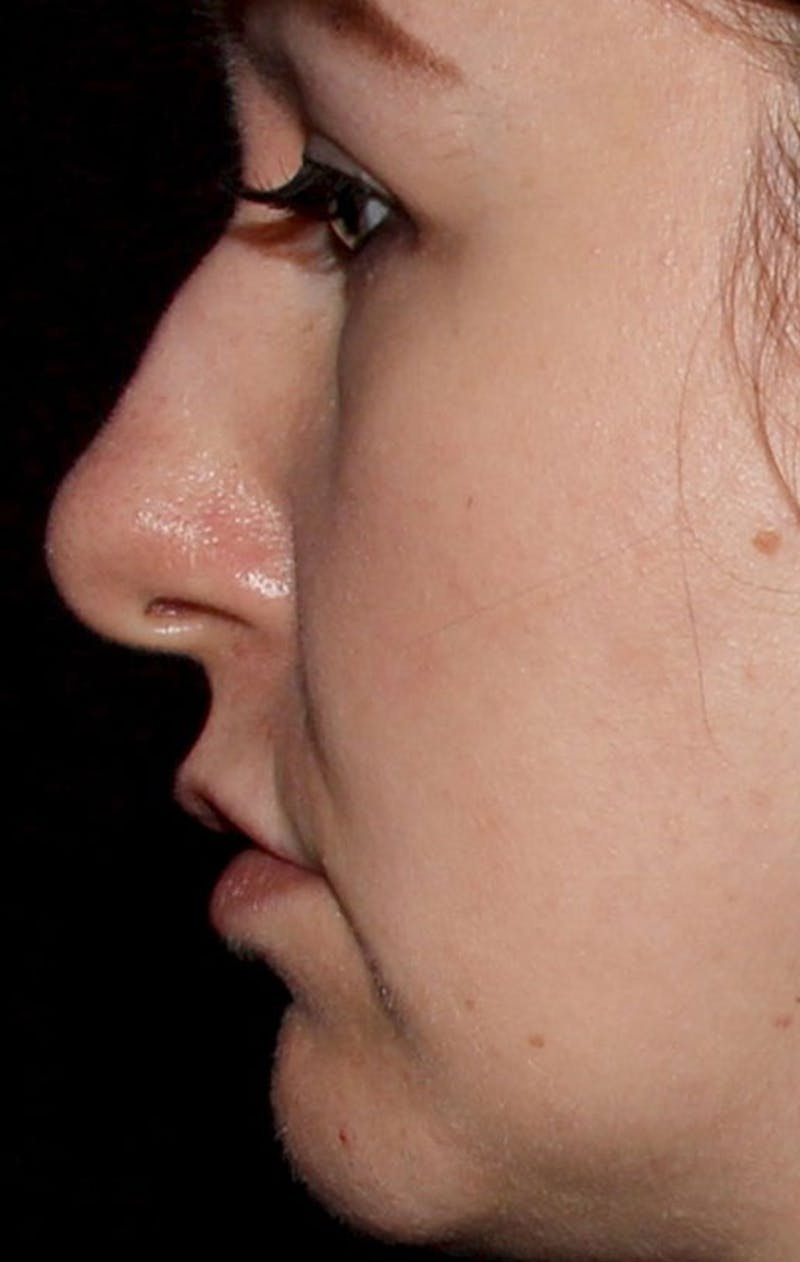 Dermal Fillers Before & After Gallery - Patient 133024047 - Image 1