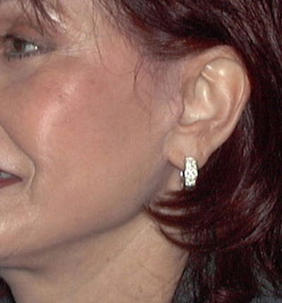 Facelift Scar Before & After Gallery - Patient 133024048 - Image 2