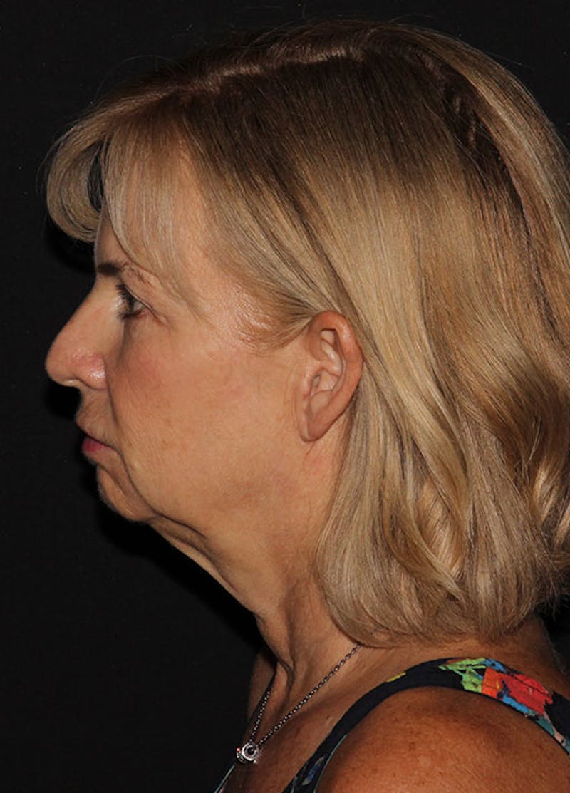 Facelift & Necklift Before & After Gallery - Patient 133024054 - Image 3