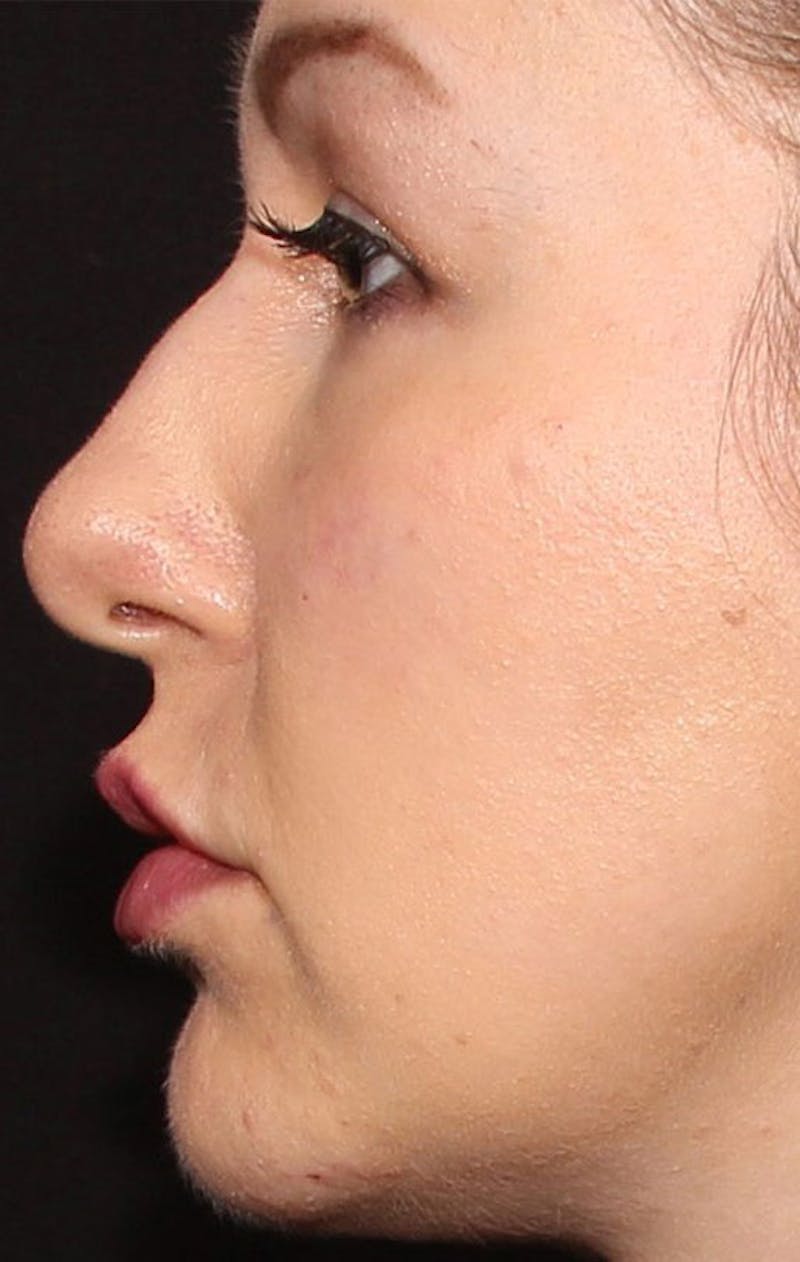 Dermal Fillers Before & After Gallery - Patient 133024047 - Image 2