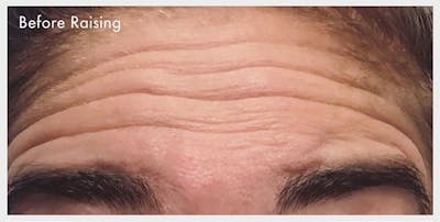 BOTOX Before & After Gallery - Patient 133024049 - Image 1