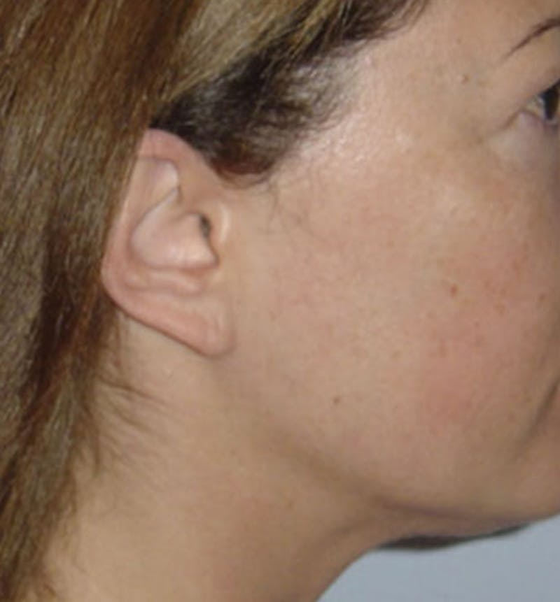 Facelift Scar Before & After Gallery - Patient 133024050 - Image 1