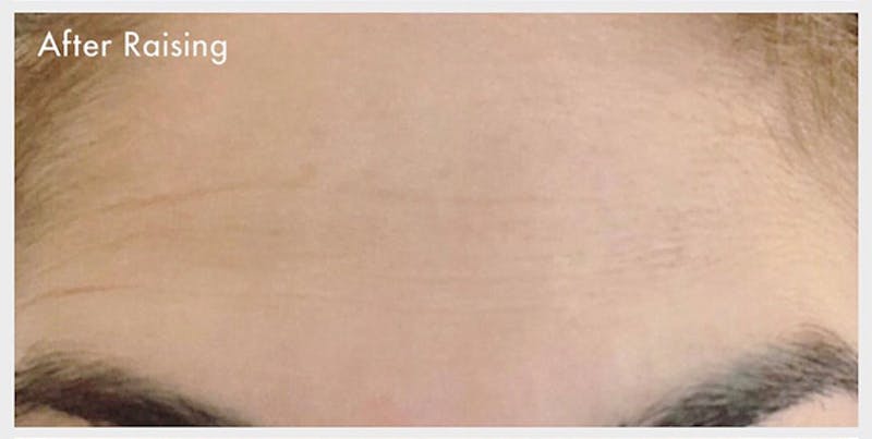 BOTOX Before & After Gallery - Patient 133024049 - Image 2