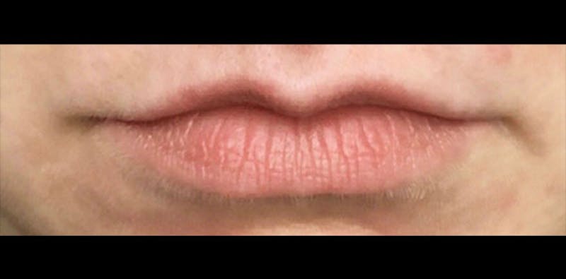 Lip Enhancement Before & After Gallery - Patient 133024058 - Image 1