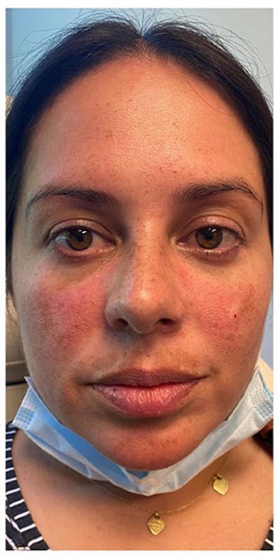 Dermal Fillers Before & After Gallery - Patient 133024055 - Image 2