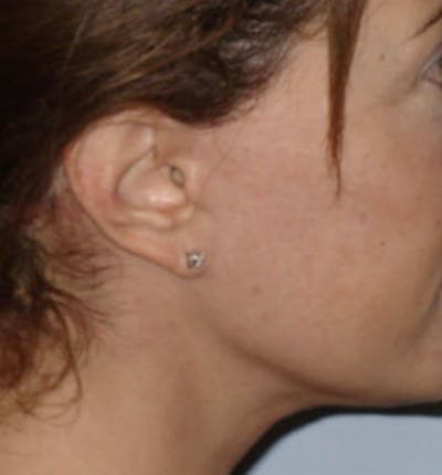Facelift Scar Before & After Gallery - Patient 133024050 - Image 2