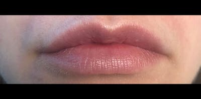 Lip Enhancement Before & After Gallery - Patient 133024058 - Image 2