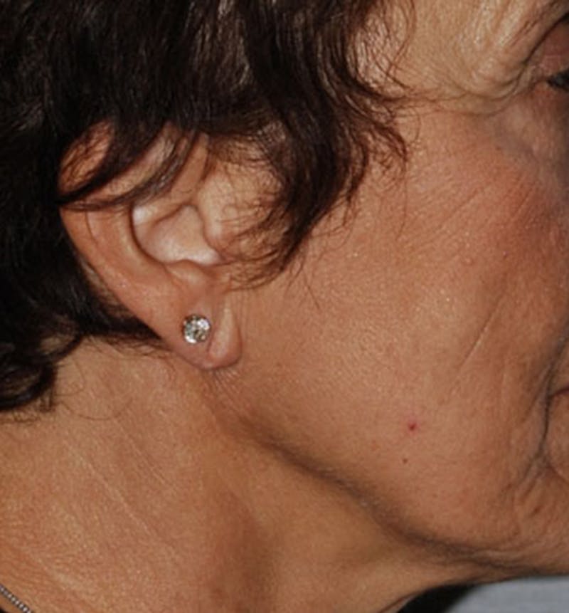 Facelift Scar Before & After Gallery - Patient 133024052 - Image 1