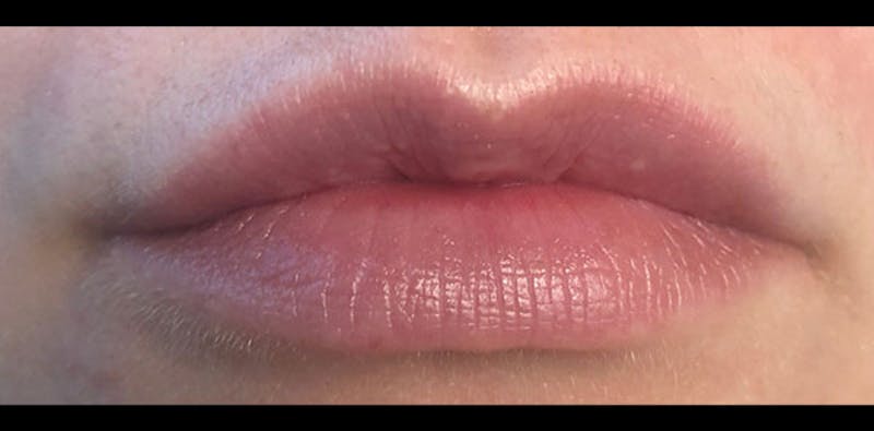 Lip Enhancement Before & After Gallery - Patient 133024058 - Image 3