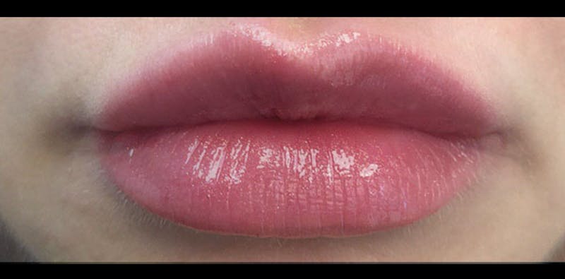 Lip Enhancement Before & After Gallery - Patient 133024058 - Image 4