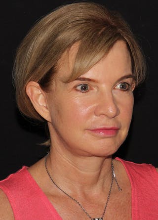 Facelift & Necklift Before & After Gallery - Patient 133024054 - Image 8