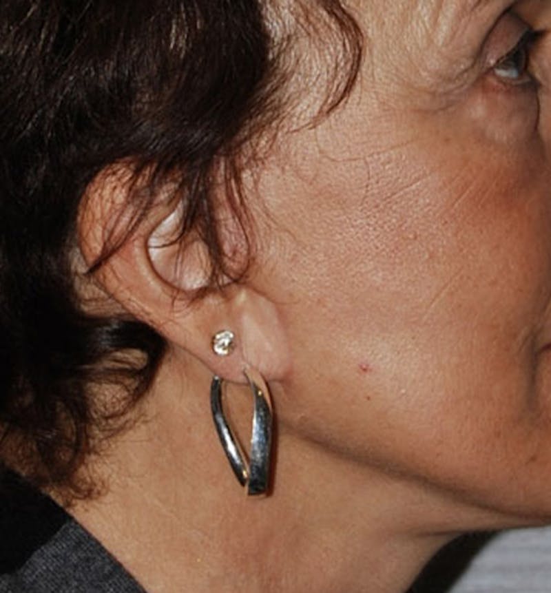 Facelift Scar Before & After Gallery - Patient 133024052 - Image 2