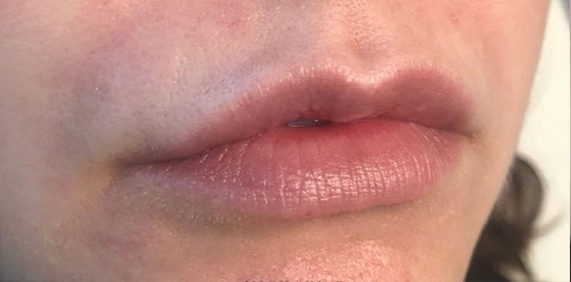 Lip Enhancement Before & After Gallery - Patient 133024058 - Image 5