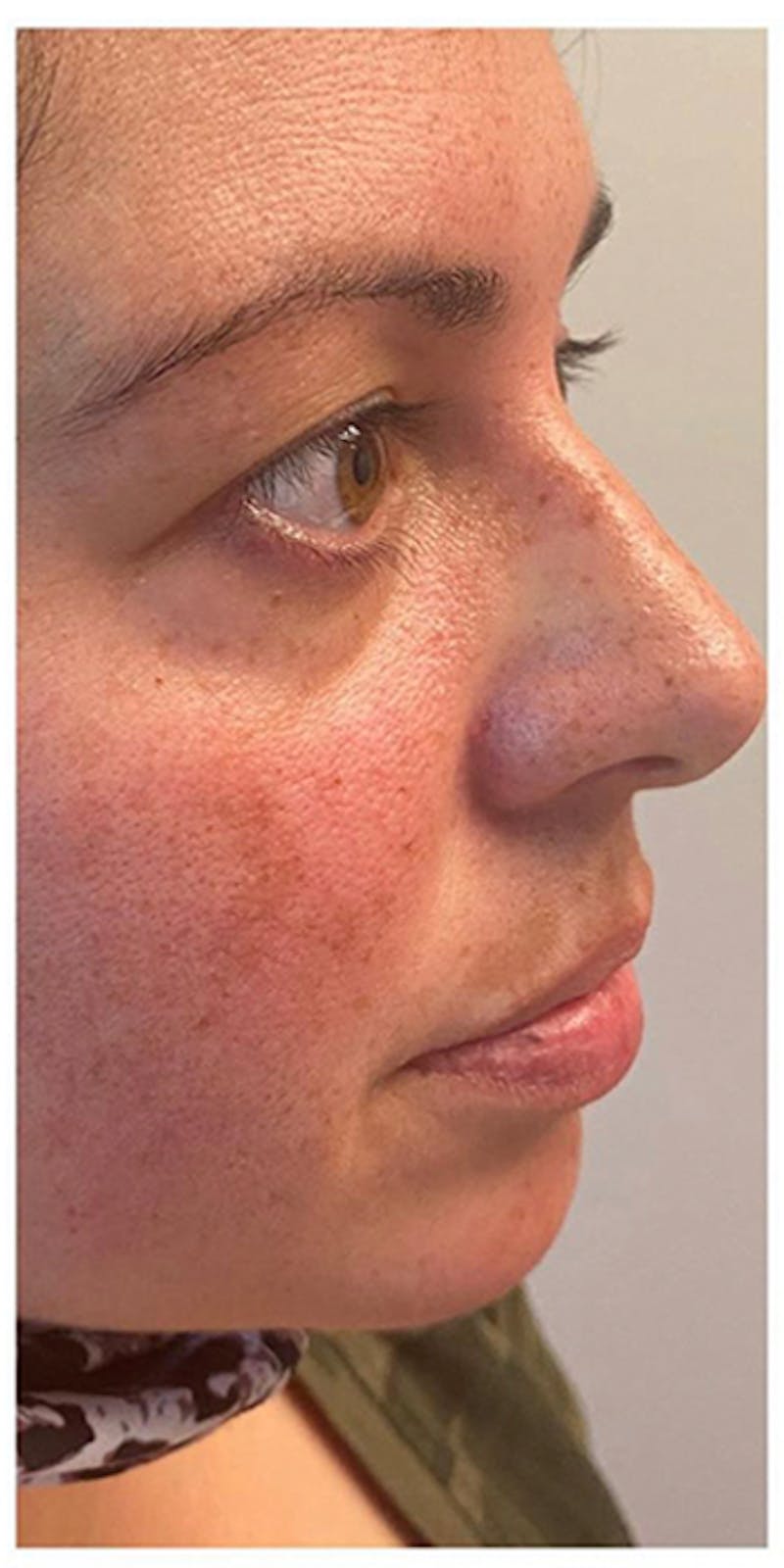 Dermal Fillers Before & After Gallery - Patient 133024055 - Image 5