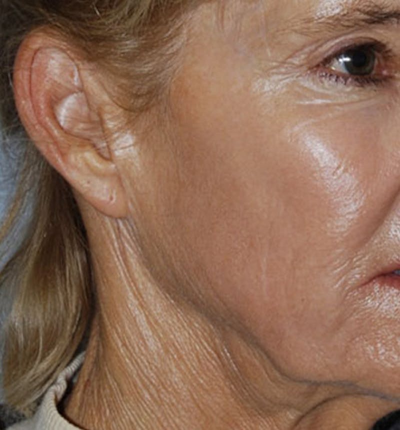 Facelift Scar Before & After Gallery - Patient 133024056 - Image 1