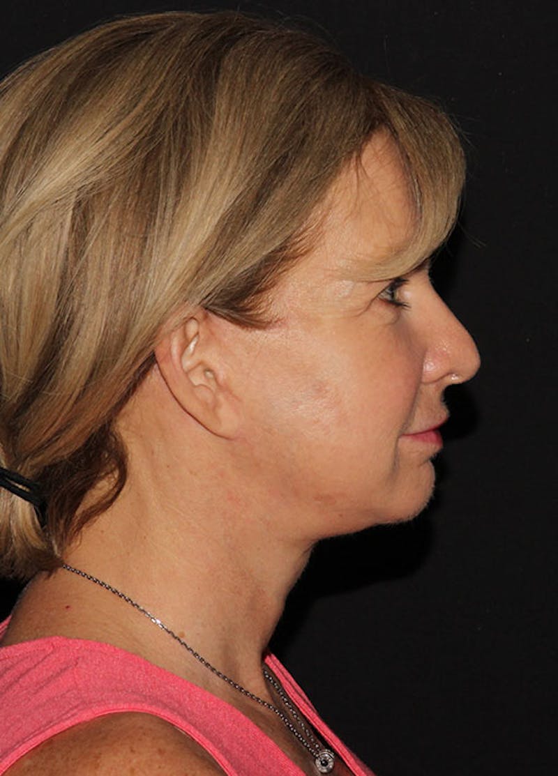 Facelift & Necklift Before & After Gallery - Patient 133024054 - Image 10