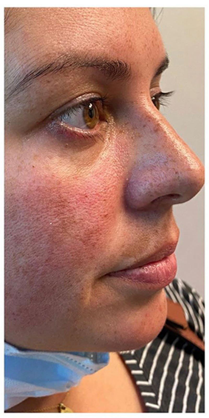 Dermal Fillers Before & After Gallery - Patient 133024055 - Image 6