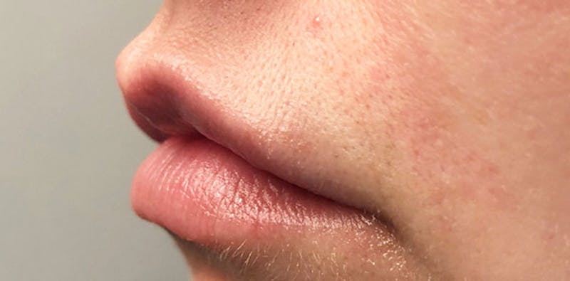Lip Enhancement Before & After Gallery - Patient 133024058 - Image 7