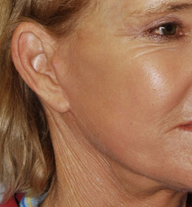 Facelift Scar Before & After Gallery - Patient 133024056 - Image 2