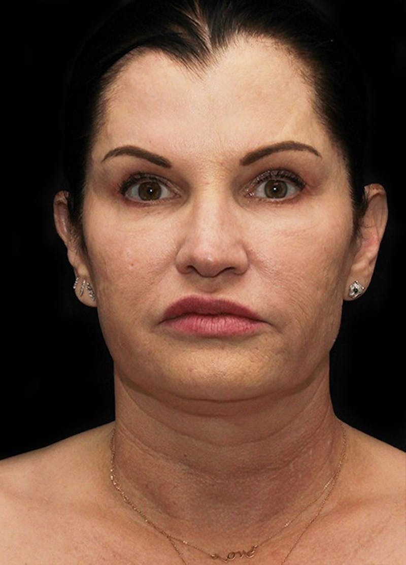 Facelift & Necklift Before & After Gallery - Patient 133024066 - Image 1