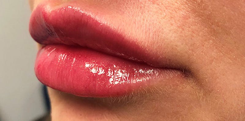 Lip Enhancement Before & After Gallery - Patient 133024058 - Image 8
