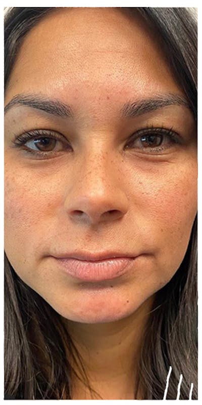 Dermal Fillers Before & After Gallery - Patient 133024070 - Image 1