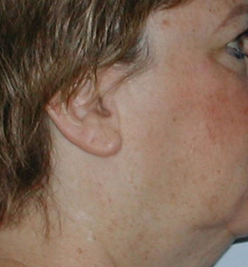 Facelift Scar Before & After Gallery - Patient 133024059 - Image 1
