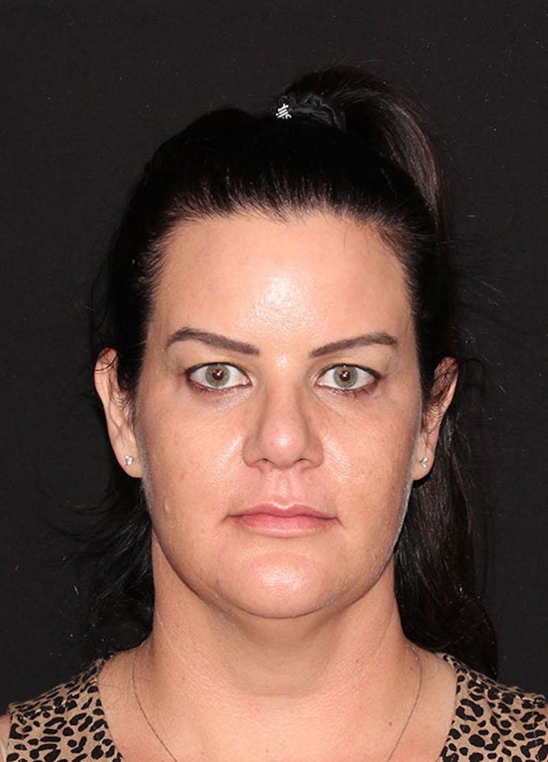 FaceTite Before & After Gallery - Patient 133024065 - Image 1