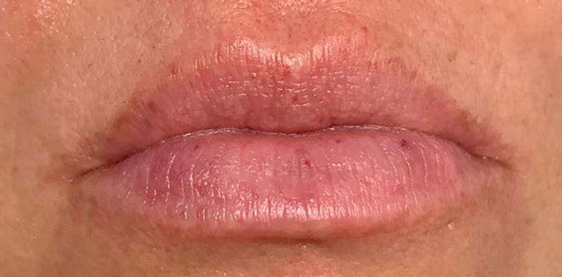 Lip Enhancement Before & After Gallery - Patient 133024063 - Image 1