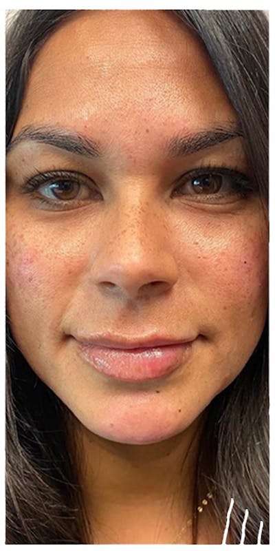 Dermal Fillers Before & After Gallery - Patient 133024070 - Image 2
