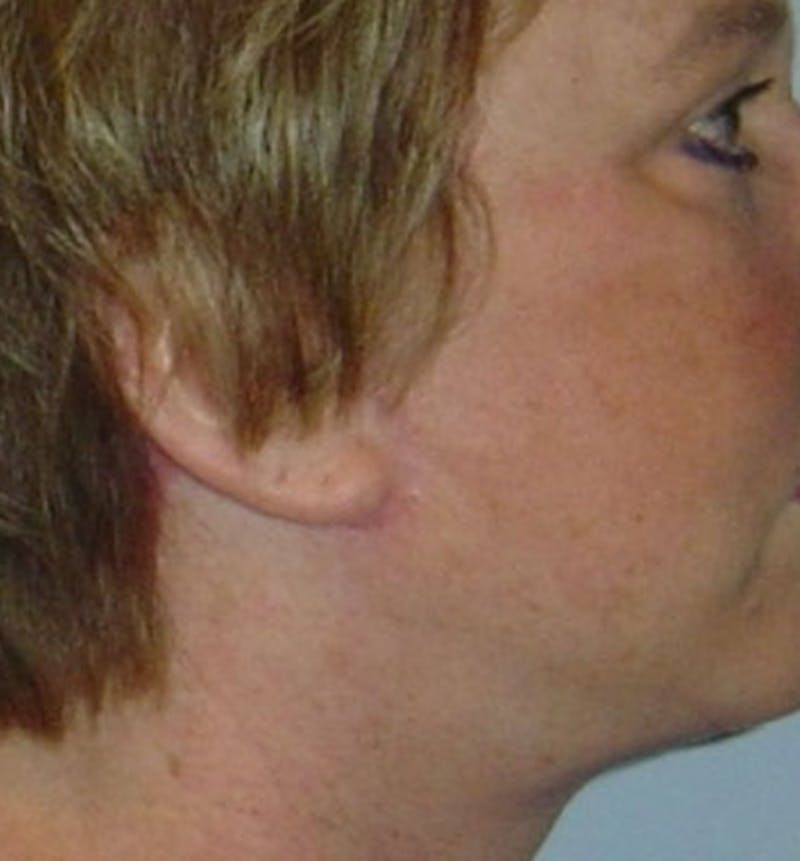 Facelift Scar Before & After Gallery - Patient 133024059 - Image 2