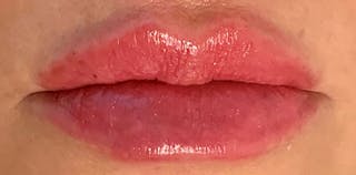 Lip Enhancement Before & After Gallery - Patient 133024063 - Image 2