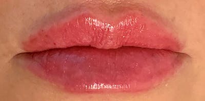 Lip Enhancement Before & After Gallery - Patient 133024063 - Image 2