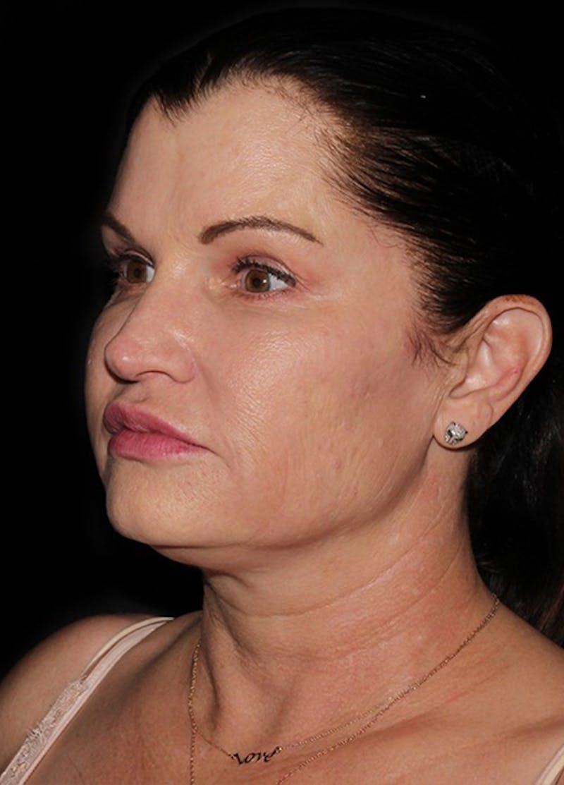 Facelift & Necklift Before & After Gallery - Patient 133024066 - Image 3