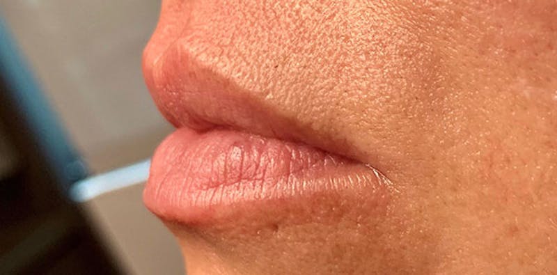 Lip Enhancement Before & After Gallery - Patient 133024063 - Image 3