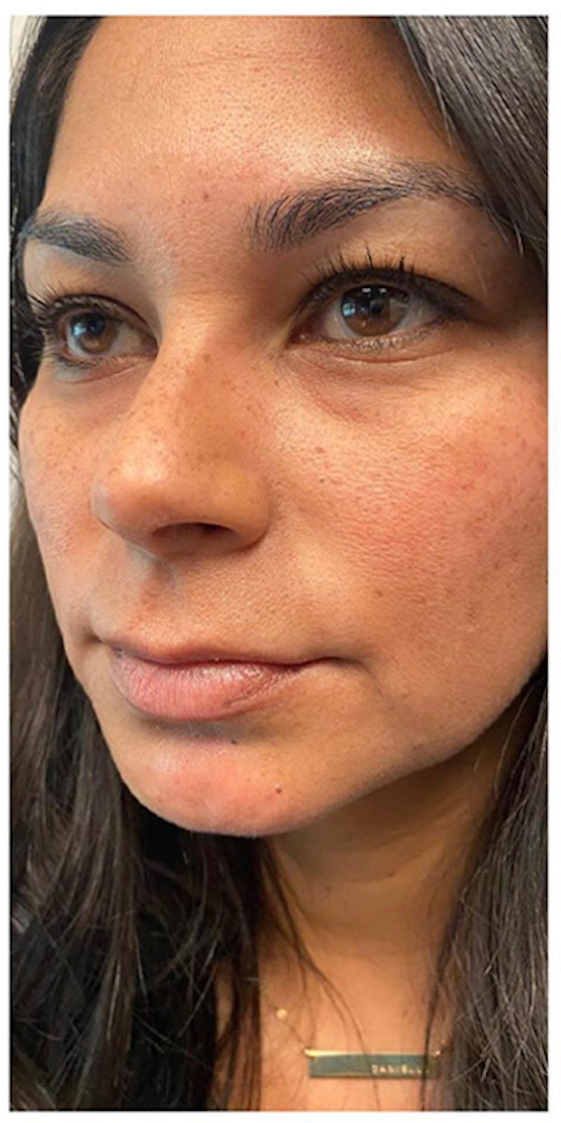 Dermal Fillers Before & After Gallery - Patient 133024070 - Image 3