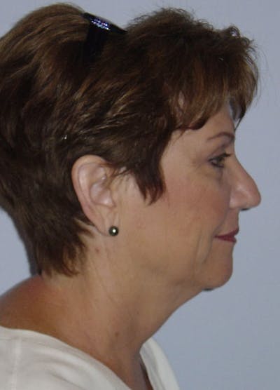 Facelift Scar Before & After Gallery - Patient 133024062 - Image 1