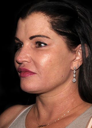 Facelift & Necklift Before & After Gallery - Patient 133024066 - Image 4