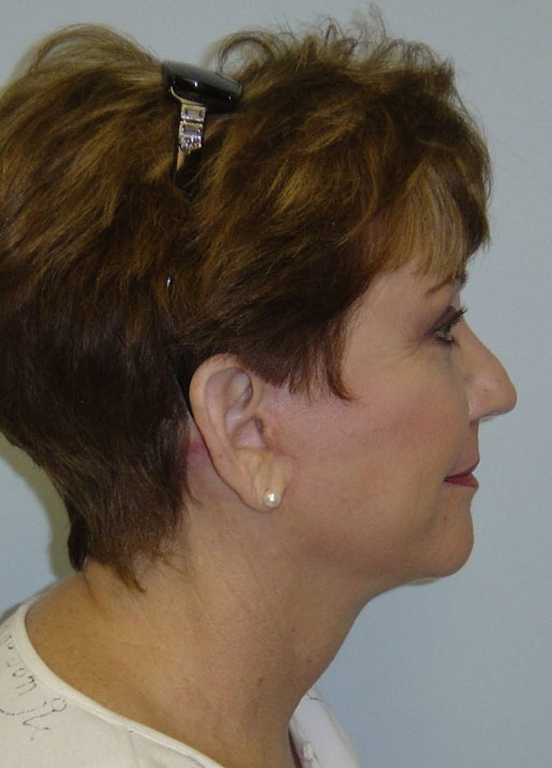 Facelift Scar Before & After Gallery - Patient 133024062 - Image 2