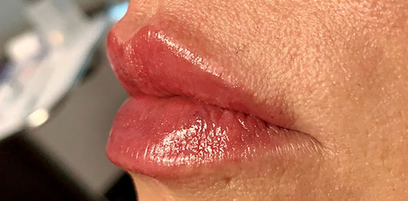 Lip Enhancement Before & After Gallery - Patient 133024063 - Image 4