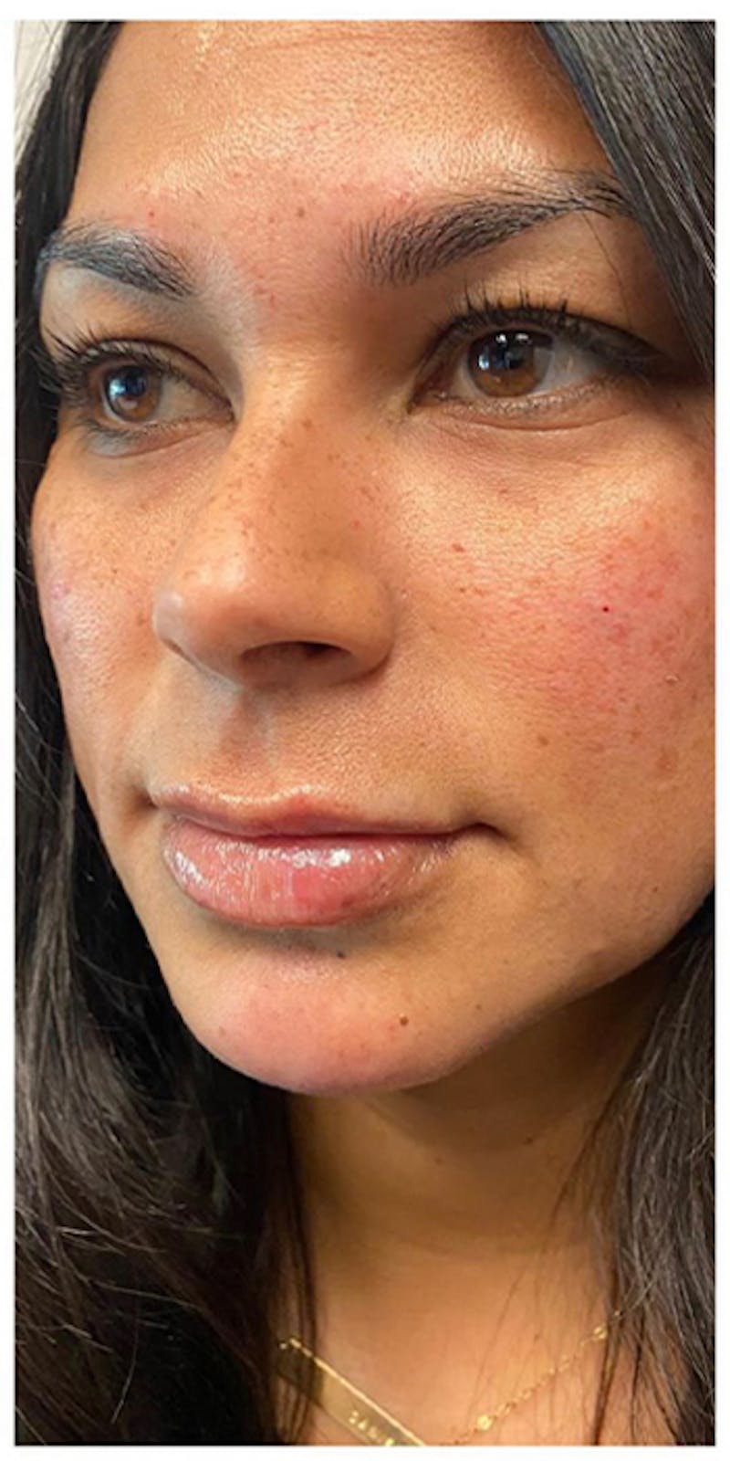 Dermal Fillers Before & After Gallery - Patient 133024070 - Image 4