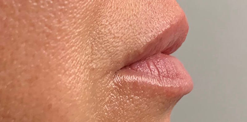 Lip Enhancement Before & After Gallery - Patient 133024063 - Image 5