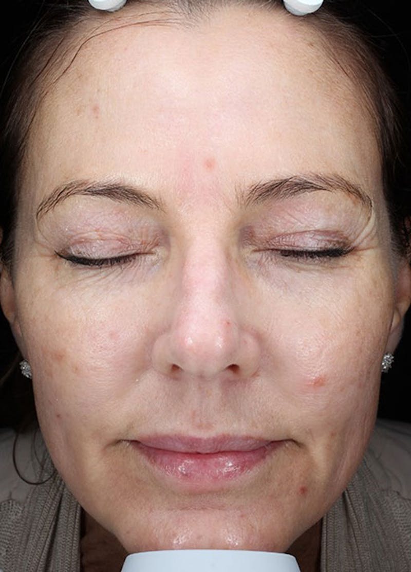 Halo Laser Before & After Gallery - Patient 133024080 - Image 1